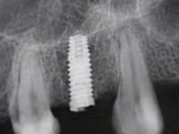 Dental X-ray showing the titanium implant screw positioned in the jawbone between the neighbouring teeth.