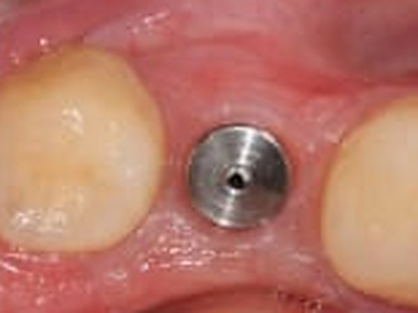 Close-up of the gum around a healing implant, showing the small metal healing cap in place between the neighbouring teeth.