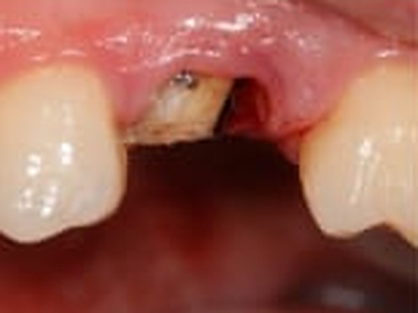 Close-up of a single missing tooth, the gap between two natural neighbouring teeth before implant treatment.
