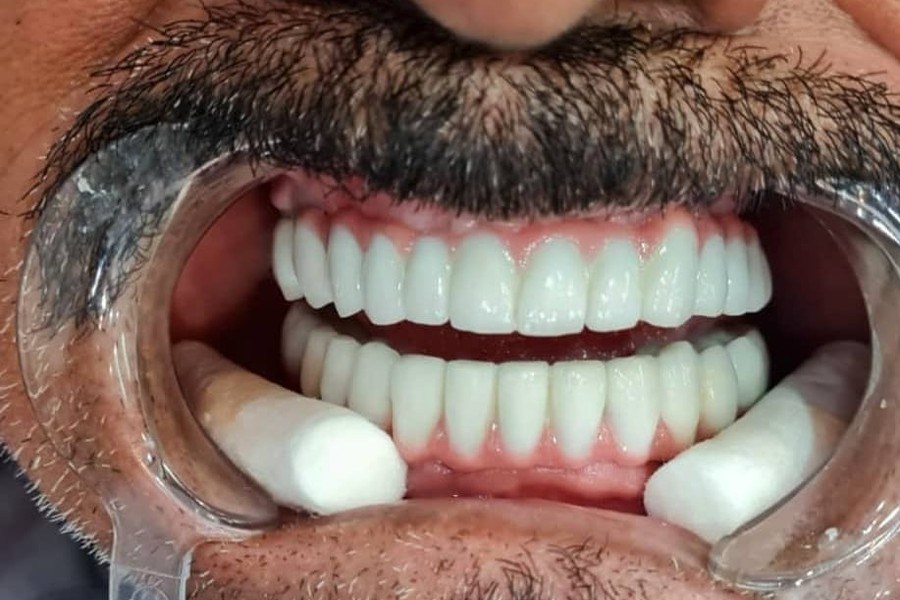 After treatment, case 02: full arc implants, upper and lower