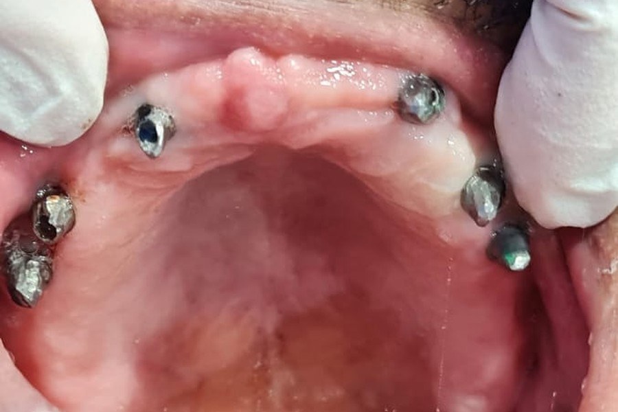 Before treatment, case 02: full arc implants, upper and lower