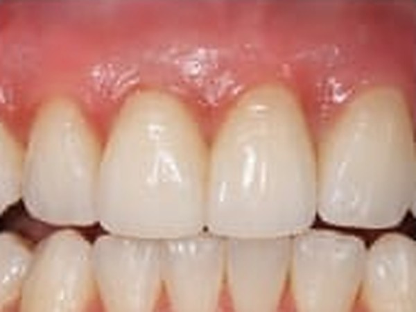 Close-up of the finished ceramic crowns fitted on the implants, blending in with the natural neighbouring teeth.