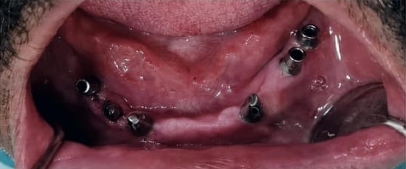 Before treatment, case 04: Full arch upper implant bridge