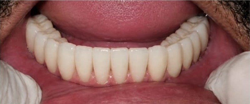 After treatment, case 04: Full arch upper implant bridge