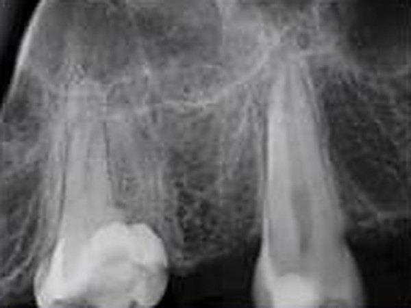 Dental X-ray of the upper jaw showing the missing tooth site and the surrounding bone before implant placement.