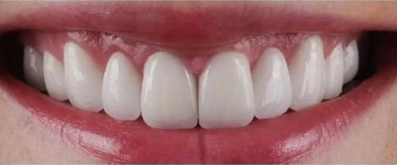 After treatment, case 01: Upper veneers