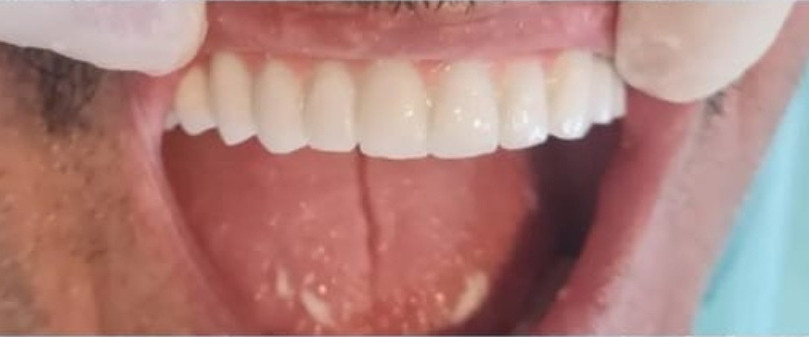 After treatment, case 03: Full arch lower implant bridge