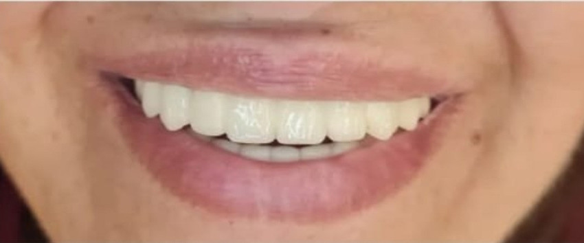 After treatment, case 05: Anterior crowns and bridgework
