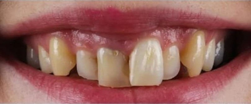 Before treatment, case 01: Upper veneers