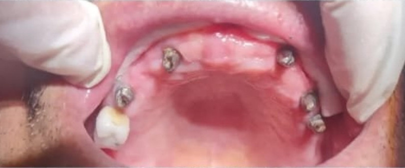 Before treatment, case 03: Full arch lower implant bridge