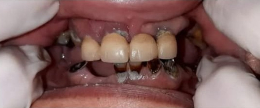 Before treatment, case 05: Anterior crowns and bridgework